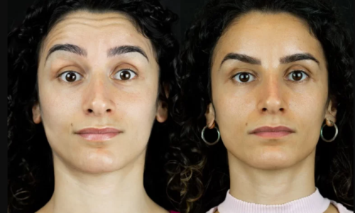 Opções de tratamento com botox