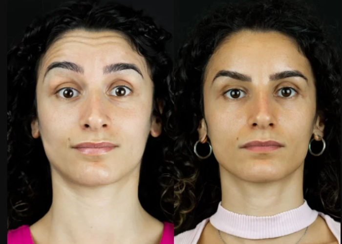 Opções de tratamento com botox