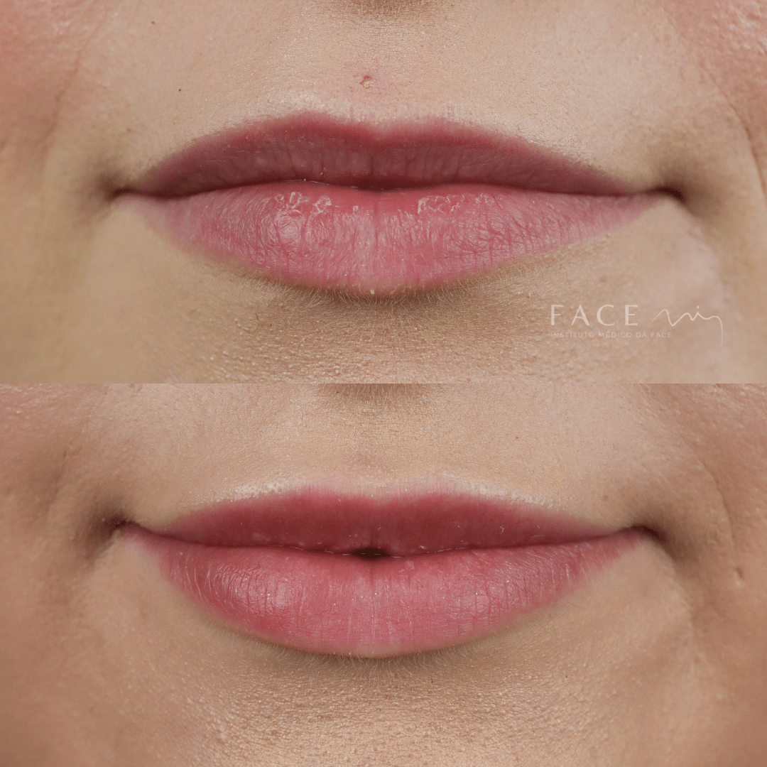 preenchimento labial