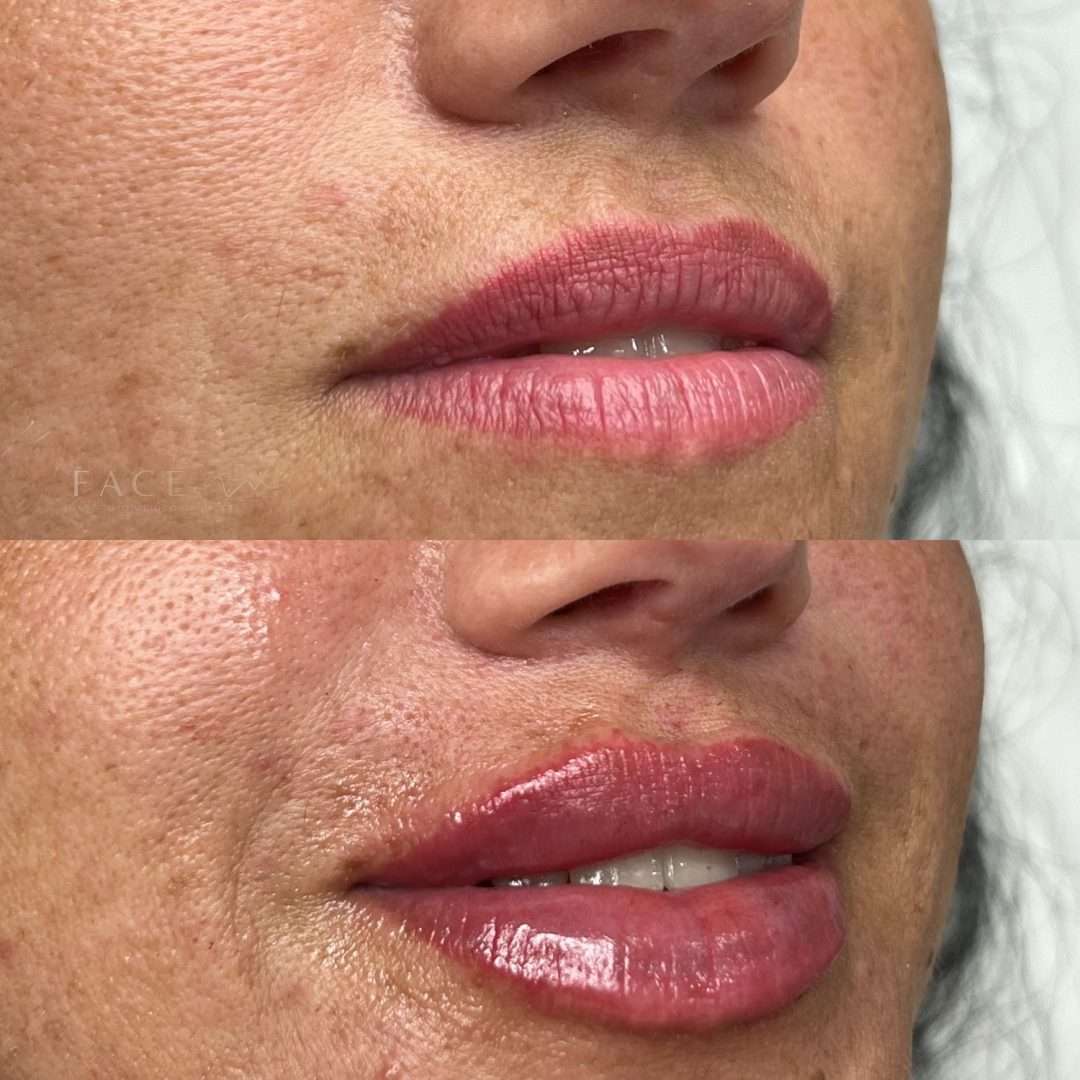 preenchimento-labial-1
