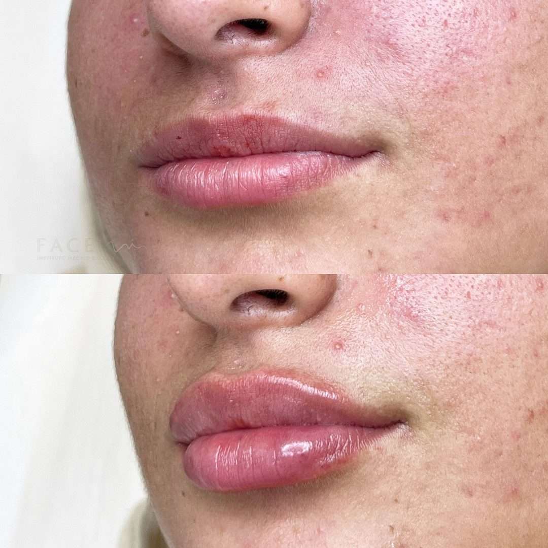 preenchimento-labial-4
