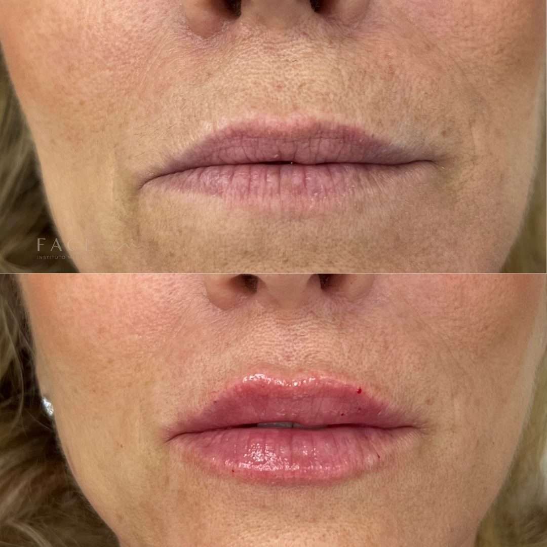 preenchimento-labial-5