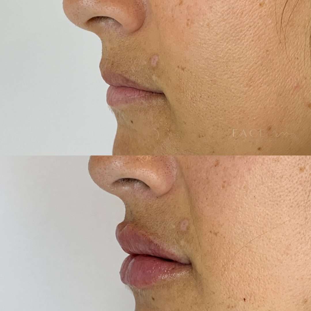 preenchimento-labial-6